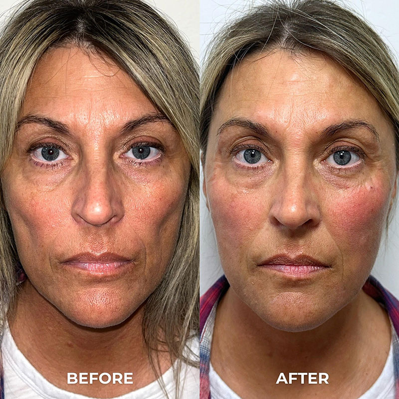 Facial Fillers Before & After Image