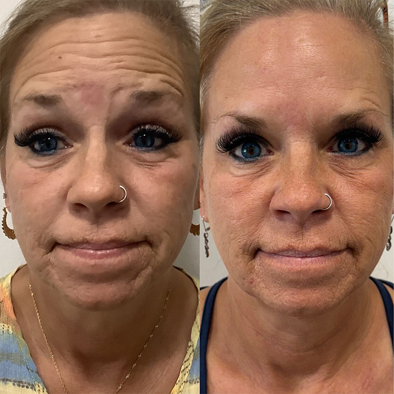 Facial Fillers Before & After Image