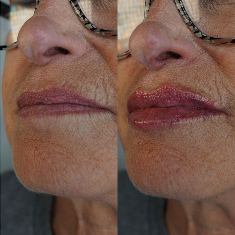 Lip Fillers Before & After Image