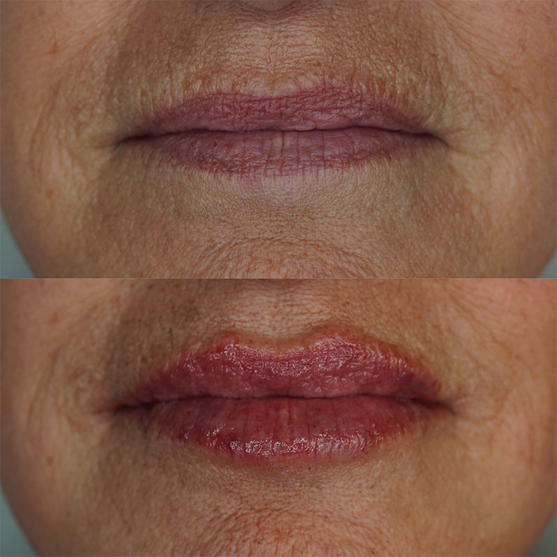 Lip Fillers Before & After Image