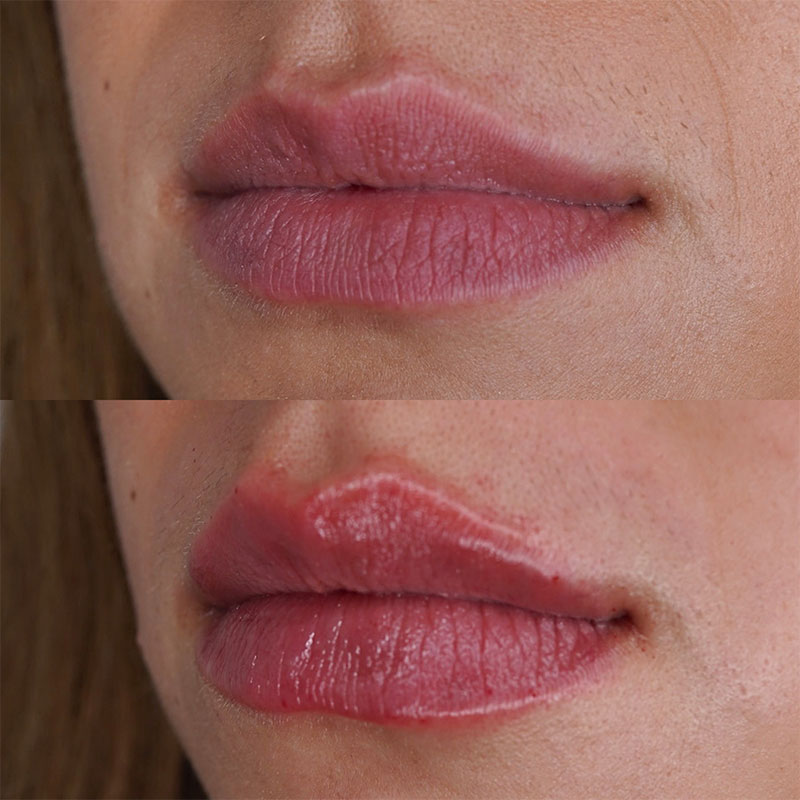 Lip Fillers Before & After Image