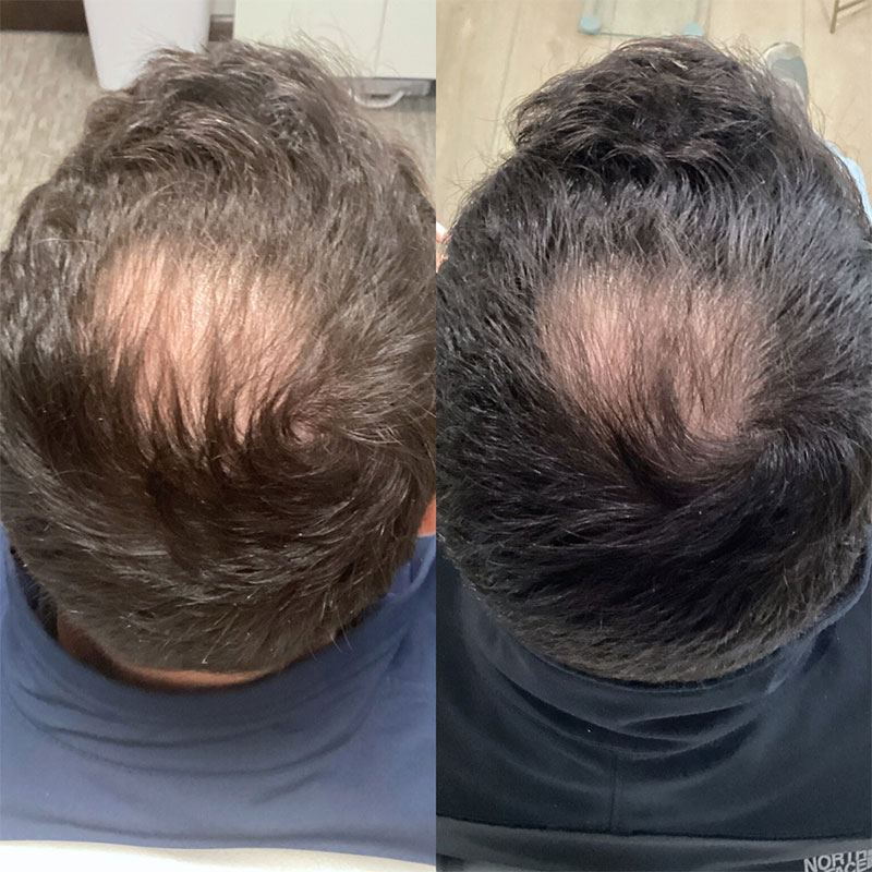 PRP Hair Restoration Before & After Image