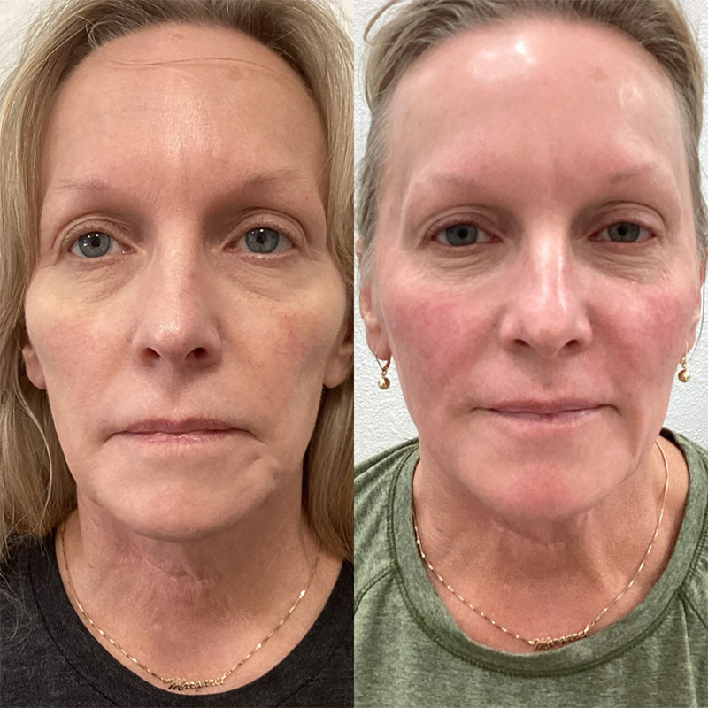 Sculptra Before & After Image