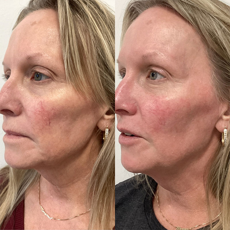 IPL Photofacial Before & After Image