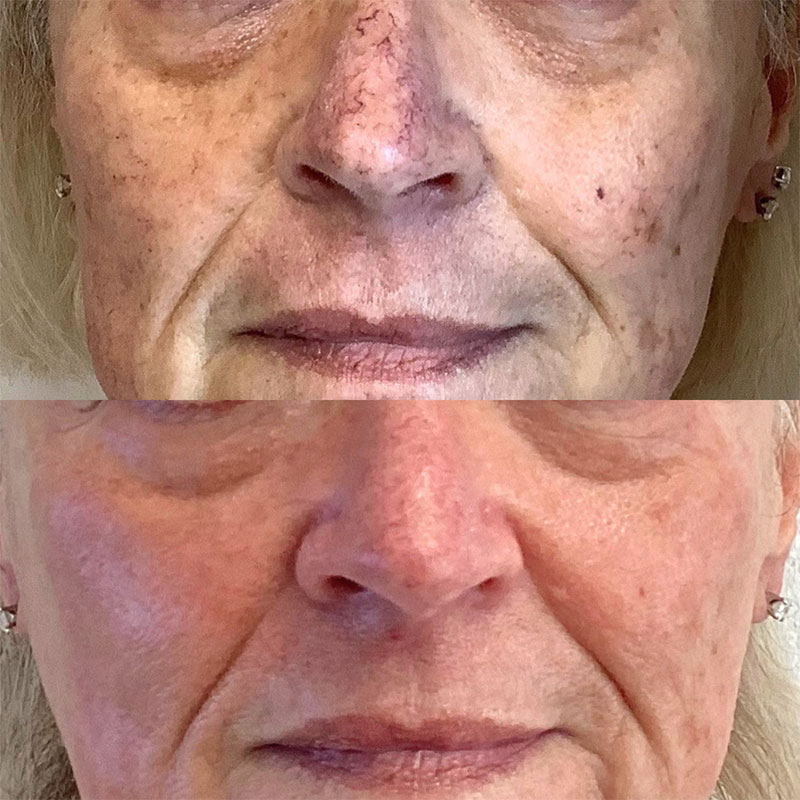 IPL Photofacial Before & After Image